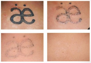 How Does Laser Tattoo Removal Work | Tattoo Removal ...